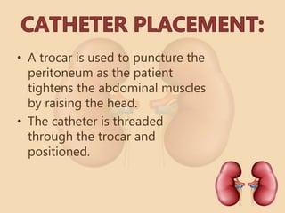 • A trocar is used to puncture the
peritoneum as the patient
tightens the abdominal muscles
by raising the head.
• The catheter is threaded
through the trocar and
positioned.
 