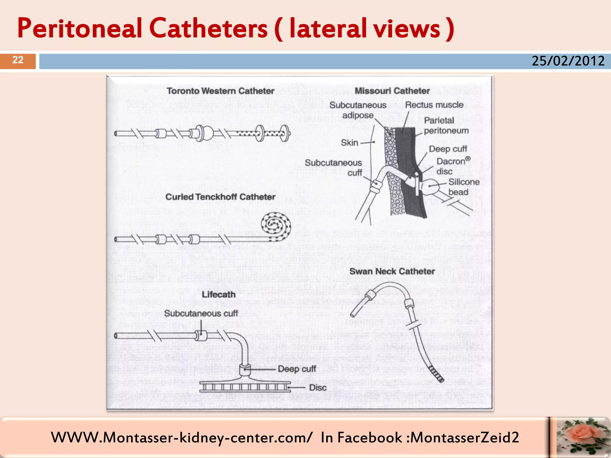 WWW.Montasser-kidney-center.com/ In Facebook :MontasserZeid2
Peritoneal Catheters ( lateral views )
22 25/02/2012
 