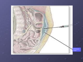 Peritoneal examination | PPT