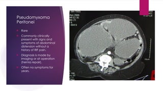 Pseudomyxoma
Peritonei
 Rare
 Commonly clinically
present with signs and
symptoms of abdominal
distension without a
history of RIF pain.
 Diagnosis is made by
imaging or at operation
(hernia repair).
 Often no symptoms for
years.
 