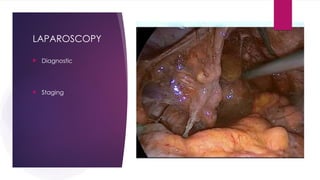 LAPAROSCOPY
 Diagnostic
 Staging
 