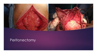 Peritonectomy
 