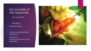 Mucocoele of
the Appendix
 Non neoplastic
 Neoplastic
Serrated polyps
Mucinous appendiceal
neoplasms
Mucinous
adenocarcinomas of the
appendix
 