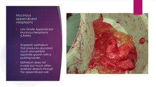 Mucinous
appendiceal
neoplasms
 Low Grade Appendiceal
Mucinous Neoplasms
(LAMNs)
 Dysplastic epithelium
that produces abundant
mucin and exhibits
expansile growth with a
pushing border.
 Epithelium does not
invade but mucin often
acellular dissects through
the appendiceal wall
 