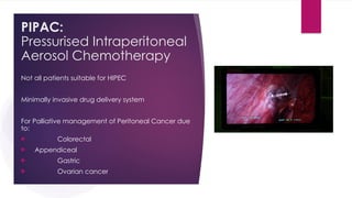 PIPAC:
Pressurised Intraperitoneal
Aerosol Chemotherapy
Not all patients suitable for HIPEC
Minimally invasive drug delivery system
For Palliative management of Peritoneal Cancer due
to:
 Colorectal
 Appendiceal
 Gastric
 Ovarian cancer
 