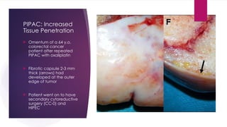 PIPAC: Increased
Tissue Penetration
 Omentum of a 64 y.o.
colorectal cancer
patient after repeated
PIPAC with oxaliplatin
 Fibrotic capsule 2-3 mm
thick (arrows) had
developed at the outer
edge of tumor
 Patient went on to have
secondary cytoreductive
surgery (CC-0) and
HIPEC
 