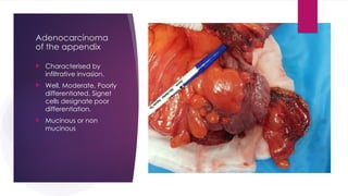 Adenocarcinoma
of the appendix
 Characterised by
infiltrative invasion.
 Well, Moderate, Poorly
differentiated. Signet
cells designate poor
differentiation.
 Mucinous or non
mucinous
 