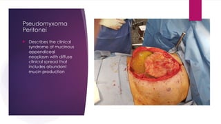 Pseudomyxoma
Peritonei
 Describes the clinical
syndrome of mucinous
appendiceal
neoplasm with diffuse
clinical spread that
includes abundant
mucin production
 