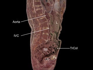 Aorta

L

IVC

TrCol

SB
Ub

Ps

 
