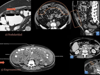 2) Nodularidad
3) Engrosamiento
 