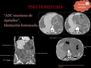 PSEUDOMIXOMA
“ADC mucinoso de
Apéndice”.
Identación festoneada.
No hay
nódulos
Radiology assistant. Peritoneum & mesentery
STATdx
 