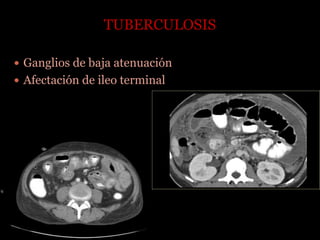 TUBERCULOSIS
 Ganglios de baja atenuación
 Afectación de ileo terminal
 