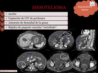 MESOTELIOMA
SERAM 2014 / S-1291
Exposición a
abesto
1
• Captación de CIV de peritoneo2
• Aumento de densidad de la grasa3
• Ascitis
3 • Rigidez de paquete vascular “estrellado”.
 