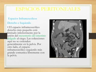 ESPACIOS PERITONEALES
Espacios Inframescolicos
Derecho e Izquierdo
• El espacio inframesocólico
derecho más pequeño está
limitado inferiormente por la
unión del mesenterio del intestino
delgado al ciego. Las colecciones
aquí no se extienden
generalmente en la pelvis. Por
otro lado, el espacio
inframesocólico izquierdo más
grande comunica libremente con
la pelvis.
 