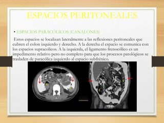 ESPACIOS PERITONEALES
• ESPACIOS PARACÓLICOS (CANALONES)
Estos espacios se localizan lateralmente a las reflexiones peritoneales que
cubren el colon izquierdo y derecho. A la derecha el espacio se comunica con
los espacios supracolicos. A la izquierda, el ligamento frenocólico es un
impedimento relativo pero no completo para que los procesos patológicos se
trasladen de paracólica izquierdo al espacio subfrénico.
 