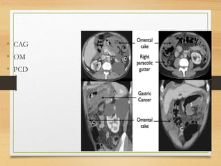 • CAG
• OM
• PCD
 