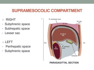 SUPRAMESOCOLIC COMPARTMENT
 RIGHT
• Subphrenic space
• Subhepatic space
• Lesser sac
 LEFT
• Perihepatic space
• Subphrenic space
•
PARASAGITTAL SECTION
 