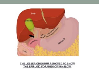 THE LESSER OMENTUM REMOVED TO SHOW
THE EPIPLOIC FORAMEN OF WINSLOW.
 