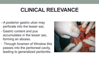 CLINICAL RELEVANCE
A posterior gastric ulcer may
perforate into the lesser sac.
• Gastric content and pus
accumulates in the lesser sac,
forming an abcess.
• Through foramen of Winslow this
passes into the peritoneal cavity,
leading to generalized peritonitis.
 