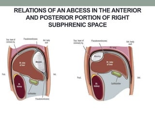 RELATIONS OF AN ABCESS IN THE ANTERIOR
AND POSTERIOR PORTION OF RIGHT
SUBPHRENIC SPACE
 