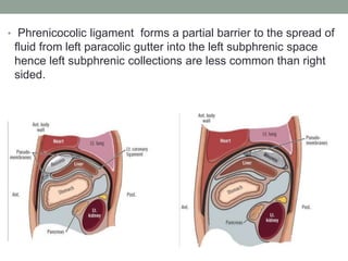 • Phrenicocolic ligament forms a partial barrier to the spread of
fluid from left paracolic gutter into the left subphrenic space
hence left subphrenic collections are less common than right
sided.
 