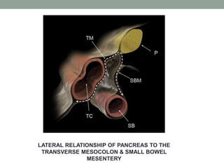 LATERAL RELATIONSHIP OF PANCREAS TO THE
TRANSVERSE MESOCOLON & SMALL BOWEL
MESENTERY
 