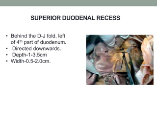 SUPERIOR DUODENAL RECESS
• Behind the D-J fold, left
of 4th part of duodenum.
• Directed downwards.
• Depth-1-3.5cm
• Width-0.5-2.0cm.
 