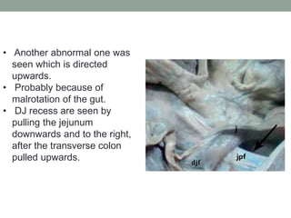 • Another abnormal one was
seen which is directed
upwards.
• Probably because of
malrotation of the gut.
• DJ recess are seen by
pulling the jejunum
downwards and to the right,
after the transverse colon
pulled upwards.
 