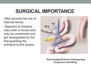 SURGICAL IMPORTANCE
• May become the site of
internal hernia.
• Segment of intestine
may enter a recess and
may be constricted and
get strangulated by the
fold guarding the
entrance to the recess.
Para duodenal hernia showing loop
of jejunum herniating.
 