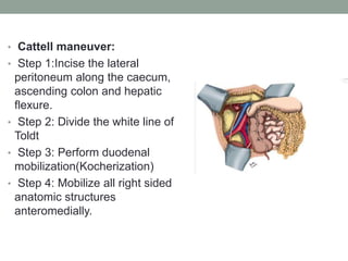 • Cattell maneuver:
• Step 1:Incise the lateral
peritoneum along the caecum,
ascending colon and hepatic
flexure.
• Step 2: Divide the white line of
Toldt
• Step 3: Perform duodenal
mobilization(Kocherization)
• Step 4: Mobilize all right sided
anatomic structures
anteromedially.
 