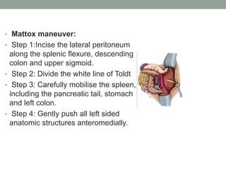 • Mattox maneuver:
• Step 1:Incise the lateral peritoneum
along the splenic flexure, descending
colon and upper sigmoid.
• Step 2: Divide the white line of Toldt
• Step 3: Carefully mobilise the spleen,
including the pancreatic tail, stomach
and left colon.
• Step 4: Gently push all left sided
anatomic structures anteromedially.
 