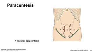 Paracentesis
X sites for paracentesis
 