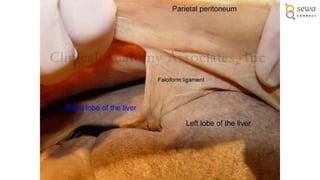 Peritoneum Defect The entire Peritoneum Anatomy and applied | PPTX