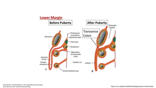 Peritoneum Defect Peritoneum | PPTX