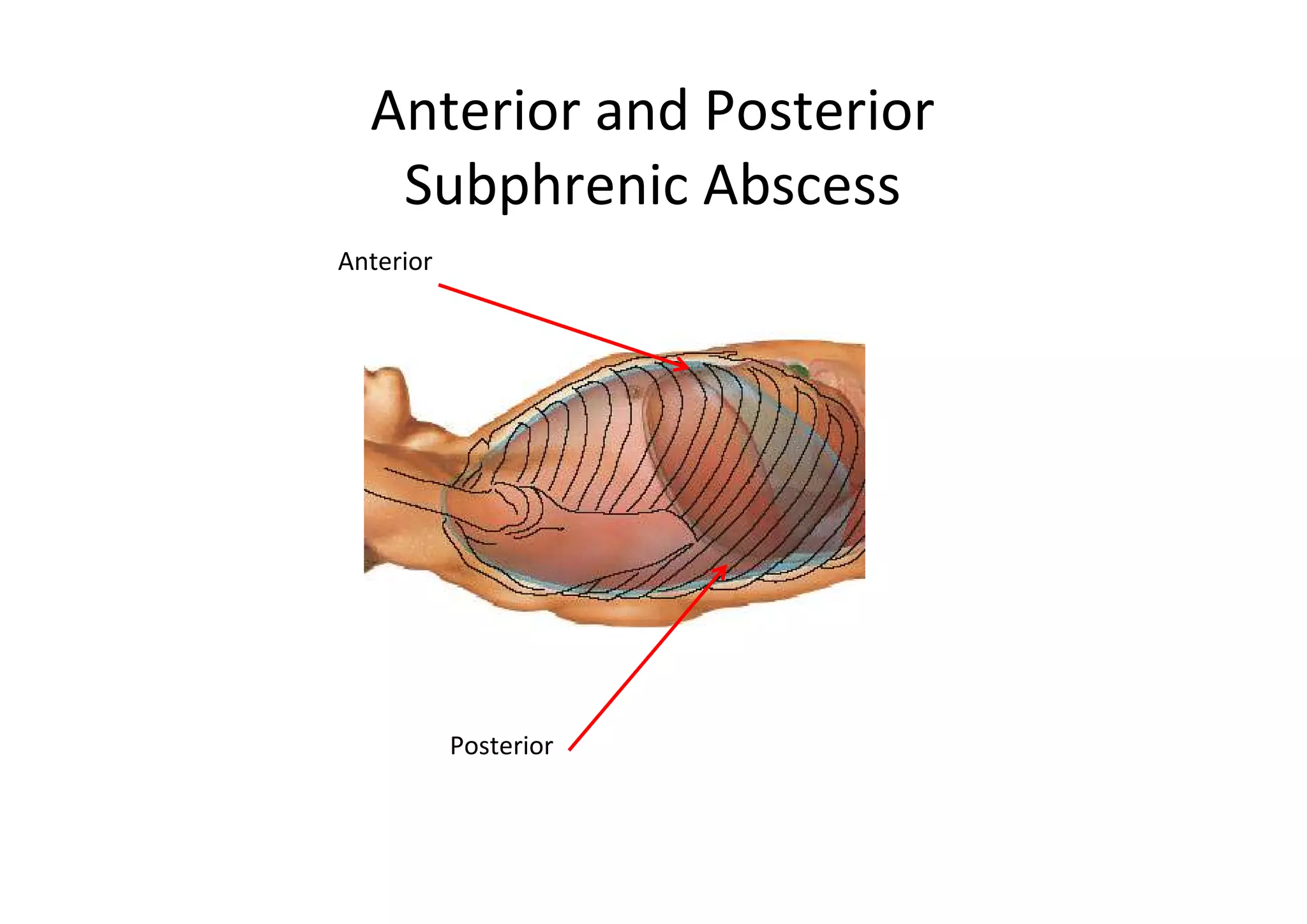 Anterior and Posterior
   Subphrenic Abscess
Anterior




           Posterior
 