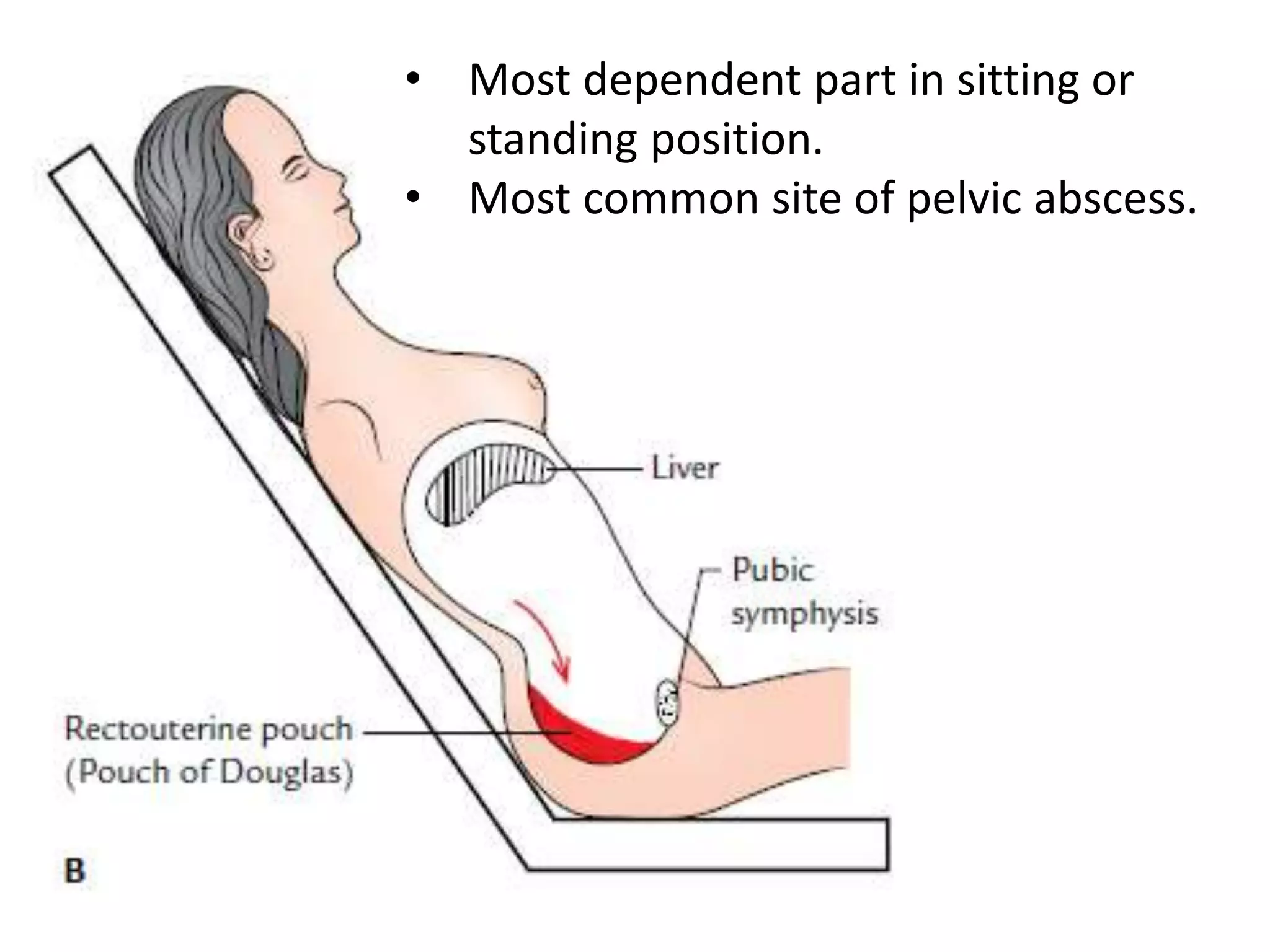 • Most dependent part in sitting or
standing position.
• Most common site of pelvic abscess.
 