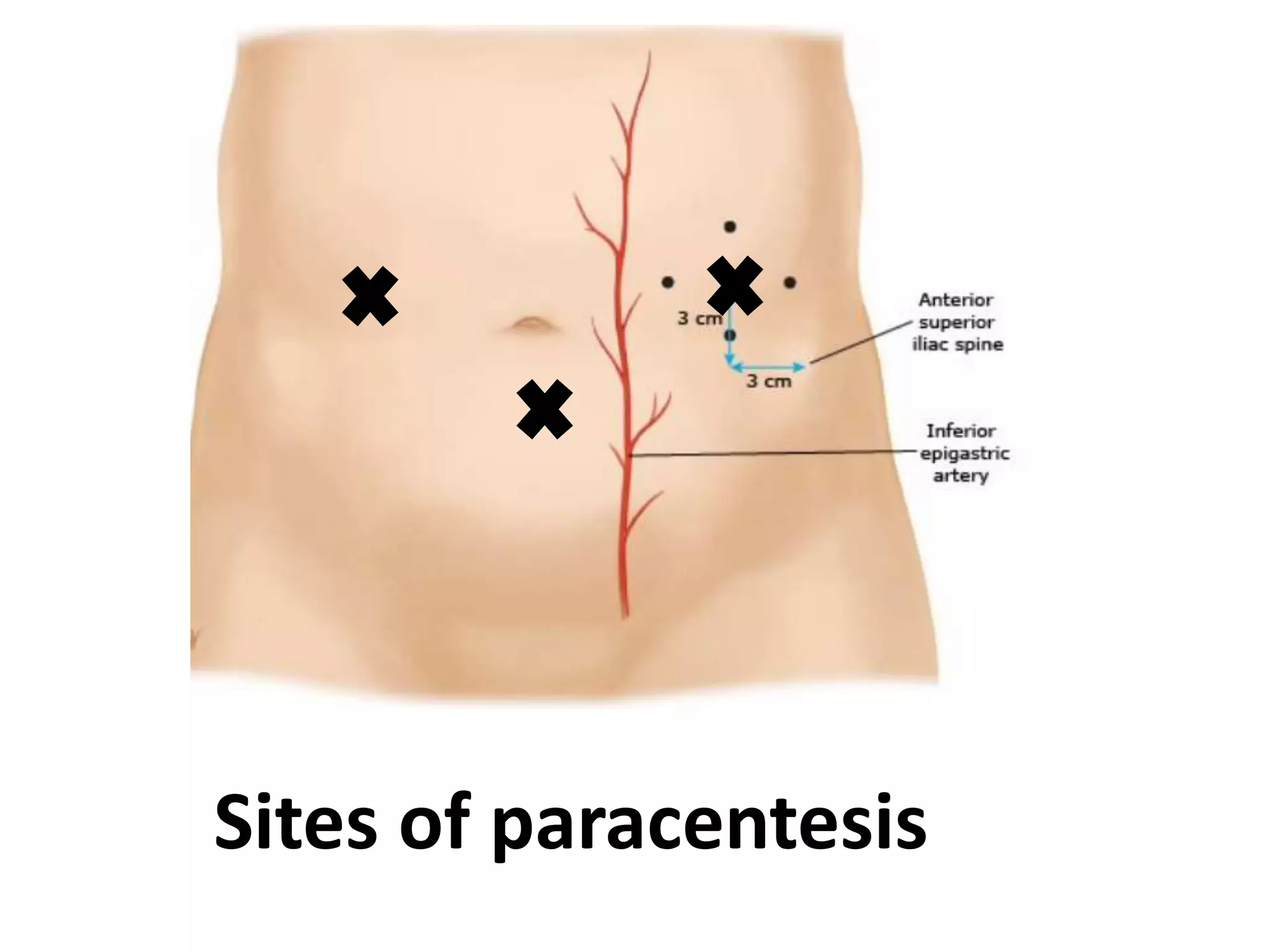 Sites of paracentesis
 
