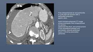 Free intraperitoneal air and peritonitis
in a 94-year-old woman with a
perforated prepyloric
gastric ulcer.
Axial contrast-enhanced CT image
shows prehepatic free intraperitoneal
air (arrow),
peritoneal free fluid, and enhancement
of the parietal(arrowhead) and
perihepatic visceral peritoneal
layers, indicating associated
peritonitis.
 
