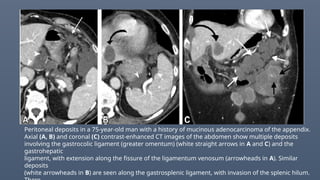 Peritoneal deposits in a 75-year-old man with a history of mucinous adenocarcinoma of the appendix.
Axial (A, B) and coronal (C) contrast-enhanced CT images of the abdomen show multiple deposits
involving the gastrocolic ligament (greater omentum) (white straight arrows in A and C) and the
gastrohepatic
ligament, with extension along the fissure of the ligamentum venosum (arrowheads in A). Similar
deposits
(white arrowheads in B) are seen along the gastrosplenic ligament, with invasion of the splenic hilum.
 