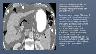 Intraperitoneal pseudomyxoma
peritonei due to appendiceal
mucinous adenocarcinomain a 66-
year-old woman.
Axial contrast-enhanced CT image of
the upper abdomen shows multiple
low-attenuation lesions involving
the lesser omentum (curved black
arrow); the gastrosplenic ligament
(straight black arrow); and
subhepatic, perihepatic, and
perisplenic spaces(white arrows).
The lesions cause mass effect on
adjacent structures and
characteristic “scalloping”of the liver
surface (arrowheads), in addition to
central displacement of small bowel
loops and the mesentery (not
shown).
 