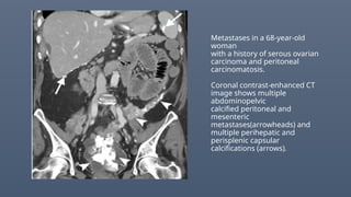 Metastases in a 68-year-old
woman
with a history of serous ovarian
carcinoma and peritoneal
carcinomatosis.
Coronal contrast-enhanced CT
image shows multiple
abdominopelvic
calcified peritoneal and
mesenteric
metastases(arrowheads) and
multiple perihepatic and
perisplenic capsular
calcifications (arrows).
 