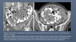 Diffuse mesenteric metastases and peritoneal carcinomatosis from breast cancer in a 52-year-old
woman. Coronal
(A) and axial (B) contrast-enhancedCT images reveal diffuse tumoral involvement of the leaves of the
mesentery (blackarrowheads) with peritoneal masses (whitearrows), diffuse peritoneal thickening
(white arrowheads), serosal involvement of the small bowel loops (black arrows), andascites.
 