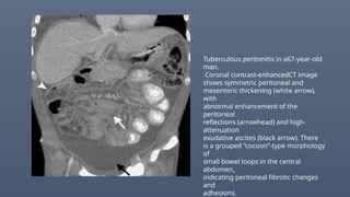 Tuberculous peritonitis in a67-year-old
man.
Coronal contrast-enhancedCT image
shows symmetric peritoneal and
mesenteric thickening (white arrow),
with
abnormal enhancement of the
peritoneal
reflections (arrowhead) and high-
attenuation
exudative ascites (black arrow). There
is a grouped “cocoon”-type morphology
of
small bowel loops in the central
abdomen,
indicating peritoneal fibrotic changes
and
adhesions.
 