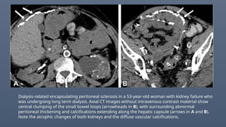 Dialysis-related encapsulating peritoneal sclerosis in a 53-year-old woman with kidney failure who
was undergoing long term dialysis. Axial CT images without intravenous contrast material show
central clumping of the small bowel loops (arrowheads in B), with surrounding abnormal
peritoneal thickening and calcifications extending along the hepatic capsule (arrows in A and B).
Note the atrophic changes of both kidneys and the diffuse vascular calcifications.
 