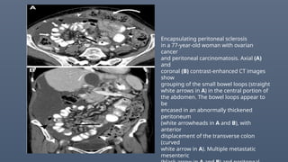 Encapsulating peritoneal sclerosis
in a 77-year-old woman with ovarian
cancer
and peritoneal carcinomatosis. Axial (A)
and
coronal (B) contrast-enhanced CT images
show
grouping of the small bowel loops (straight
white arrows in A) in the central portion of
the abdomen. The bowel loops appear to
be
encased in an abnormally thickened
peritoneum
(white arrowheads in A and B), with
anterior
displacement of the transverse colon
(curved
white arrow in A). Multiple metastatic
mesenteric
 