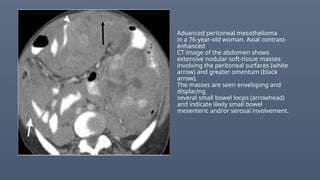 Advanced peritoneal mesothelioma
in a 76-year-old woman. Axial contrast-
enhanced
CT image of the abdomen shows
extensive nodular soft-tissue masses
involving the peritoneal surfaces (white
arrow) and greater omentum (black
arrow).
The masses are seen enveloping and
displacing
several small bowel loops (arrowhead)
and indicate likely small bowel
mesenteric and/or serosal involvement.
 
