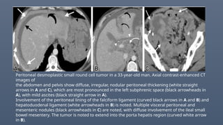 Peritoneal desmoplastic small round cell tumor in a 33-year-old man. Axial contrast-enhanced CT
images of
the abdomen and pelvis show diffuse, irregular, nodular peritoneal thickening (white straight
arrows in A and C), which are most pronounced in the left subphrenic space (black arrowheads in
A), with mild ascites (black straight arrow in A).
Involvement of the peritoneal lining of the falciform ligament (curved black arrows in A and B) and
hepatoduodenal ligament (white arrowheads in B) is noted. Multiple visceral peritoneal and
mesenteric nodules (black arrowheads in C) are noted, with diffuse involvement of the ileal small
bowel mesentery. The tumor is noted to extend into the porta hepatis region (curved white arrow
in B).
 