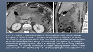 Acute pancreatitis and subperitoneal spread of inflammation in a 49-year-old man. Axial (A)
and sagittal (B) contrast-enhanced CT images of the abdomen show sequelae of necrotizing
pancreatitis, including extensive peripancreatic fat stranding and fluid collections (white arrow in
A). Inflammatory changes extend through the subperitoneal space, specifically the transverse
mesocolon and gastrocolic ligament (arrow in B). Transverse colonic wall thickening and edema
(arrowheadin A) are also noted. Inflammation is also seen extending in the left anterior pararenal
space with fluidcollection and thickening of the left anterior perinephric fascia (black arrow in A).
 