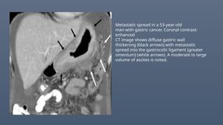Metastatic spread in a 53-year-old
man with gastric cancer. Coronal contrast-
enhanced
CT image shows diffuse gastric wall
thickening (black arrows) with metastatic
spread into the gastrocolic ligament (greater
omentum) (white arrows). A moderate to large
volume of ascites is noted.
 