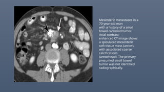 Mesenteric metastases in a
70-year-old man
with a history of a small
bowel carcinoid tumor.
Axial contrast-
enhanced CT image shows
a spiculated mesenteric
soft-tissue mass (arrow),
with associated coarse
calcifications
(arrowhead). The primary
presumed small bowel
tumor was not identified
radiographically.
 